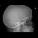 Fissure of frontal bone: X-ray - Plain radiograph